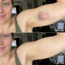 Timilk® BruiseFade Pro – Creme para Eliminar Hematomas, Reduzir Manchas Roxas e Acelerar a Recuperação da Pele