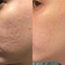 HyaRepair | Fita de Silicone para Rugas e Cicatrizes